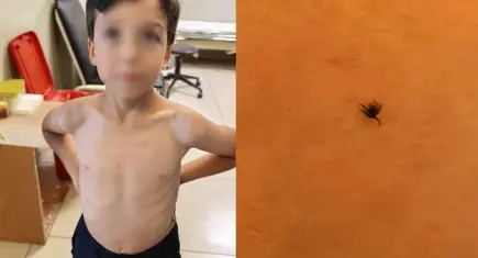 Küçük Mustafa'nın göğsüne kene yapıştı