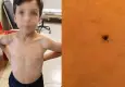 Küçük Mustafa'nın göğsüne kene yapıştı