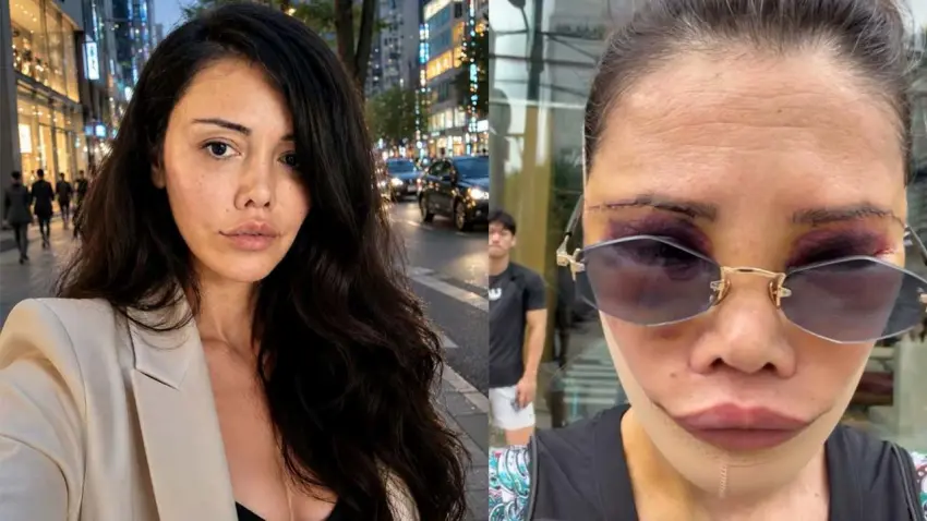 Eski Survivor yarışmacısı Didem Ceran'dan korkutan paylaşım: Deri altında kan duruyor, bir ameliyat daha gerekecek haberinin görseli