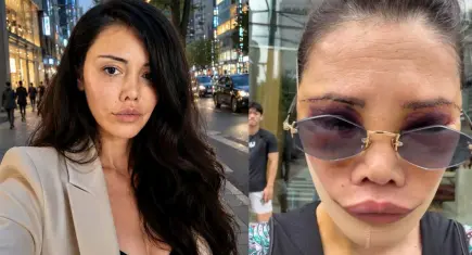 Eski Survivor yarışmacısı Didem Ceran'dan korkutan paylaşım: Deri altında kan duruyor, bir ameliyat daha gerekecek