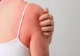 Güneş yanıkları, cilt kanseri riskini arttırıyor   haberinin görseli