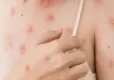 Hindistan’da ilk Maymun çiçeği virüsü görüldü haberinin görseli