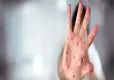 Kızamık salgınında korkutan tablo! haberinin görseli