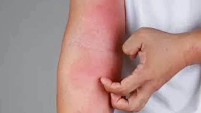 Uyuz vakaları arttı! Uyuz hastalığı belirtileri nelerdir? haberinin görseli