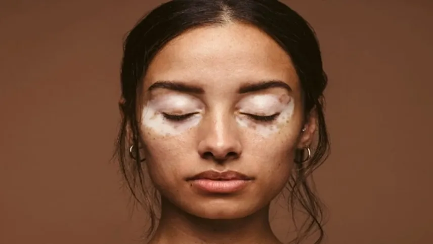 Melanin nedir? Melanin eksikliği ve fazlalığı olunca ne olur? haberinin görseli